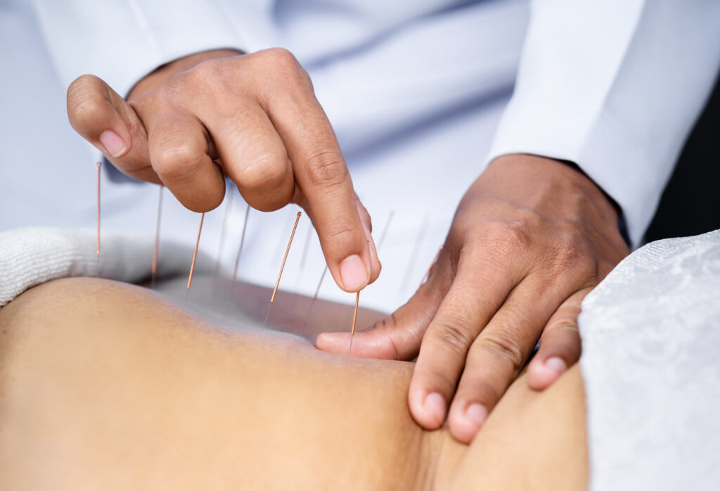 Accupuncture